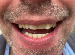 Uzupełnienie w uśmiechu korony pełnoceramiczne łuk dolny