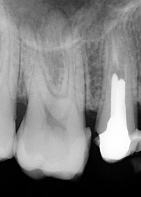 Ząb trzonowy 6 przed leczeniem endodontycznym Ząb trzonowy 6 przed leczeniem endodontycznym