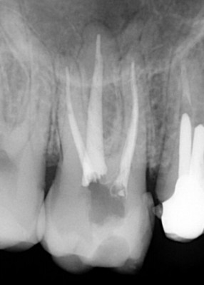 Ząb trzonowy 6 z prawidłowo wypełnionymi kanałami Ząb trzonowy 6 z prawidłowo wypełnionymi kanałami