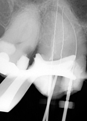 Ząb trzonowy 7 z odnalezionymi 3 kanałami w zębie Ząb trzonowy 7 z odnalezionymi 3 kanałami w zębie