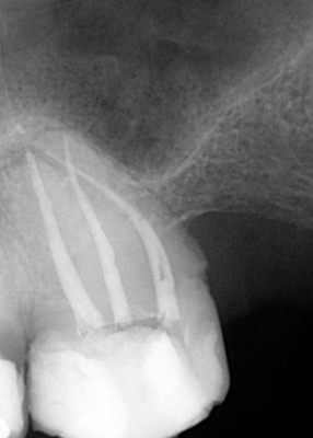 Ząb trzonowy 7 z prawidłowo wypełnionymi kanałami Ząb trzonowy 7 z prawidłowo wypełnionymi kanałami