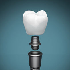 Pojedyncza korona z łącznikiem na implancie Pojedyncza korona z łącznikiem na implancie