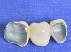 Korona protetyczna Korona protetyczna