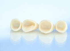 Most protetyczny wykonany w cyrkonu ( praca bez podbudowy metalowej ) Most protetyczny wykonany w cyrkonu ( praca bez podbudowy metalowej )