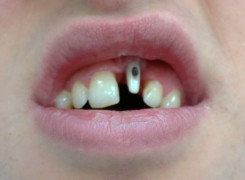 Łącznik Cyrkonowy zęba - lewa górna 1 Łącznik Cyrkonowy zęba - lewa górna 1