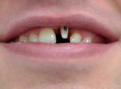 Łącznik Cyrkonowy zęba - lewa górna 1 Łącznik Cyrkonowy zęba - lewa górna 1