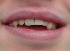 Korona Cyrkonowa zęba - lewa górna 1 Korona Cyrkonowa zęba - lewa górna 1