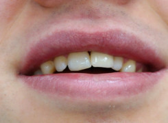 Korona Cyrkonowa zęba - lewa górna 1 Korona Cyrkonowa zęba - lewa górna 1