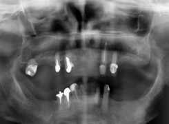 Obraz radiologiczny w chwili zgłoszenia się Pana Ryszarda do Gabinetu Obraz radiologiczny w chwili zgłoszenia się Pana Ryszarda do Gabinetu