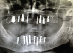 Obraz radiologiczny wykonany po zaimplantowaniu Pana Ryszarda 16 wszczepami. Obraz radiologiczny wykonany po zaimplantowaniu Pana Ryszarda 16 wszczepami.