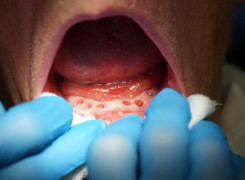 Wygojona śluzówka po 14 dniach od założenia ceramicznych śrub gojących (etap noszenia śrub gojących jest etapem który następuje po odsłonięciu implantów okresie integracji wszczepów) Etap – przygotowania do wycisków na transferach pod pracę protetyczną Wygojona śluzówka po 14 dniach od założenia ceramicznych śrub gojących (etap noszenia śrub gojących jest etapem który następuje po odsłonięciu implantów okresie integracji wszczepów) Etap – przygotowania do wycisków na transferach pod pracę protetyczną