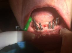 Etap wycisków na transferach w celu wykonania pracy protetycznej Etap wycisków na transferach w celu wykonania pracy protetycznej