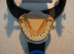 Belka cyrkonowa z cyrkonowymi koronami – widok od góry na modelu technicznym. Widoczne miejsca łączenia belki z implantami ( widoczne są tylko na etapie przymiarki ) Belka cyrkonowa z cyrkonowymi koronami – widok od góry na modelu technicznym. Widoczne miejsca łączenia belki z implantami ( widoczne są tylko na etapie przymiarki )