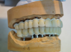 28 cyrkonowych koron – etap przygotowań na modelach technicznych 28 cyrkonowych koron – etap przygotowań na modelach technicznych