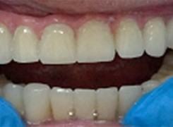 28 Koron cyrkonowych zamontowanych na belce cyrkonowej pokrytej dziąsłem ceramicznym osadzonej na 16 implantach. Praca w ustach pacjenta efekt końcowy 28 Koron cyrkonowych zamontowanych na belce cyrkonowej pokrytej dziąsłem ceramicznym osadzonej na 16 implantach. Praca w ustach pacjenta efekt końcowy